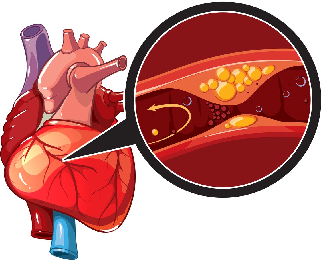 Coronary Artery Disease: Risk Factors, Symptoms, & Treatment