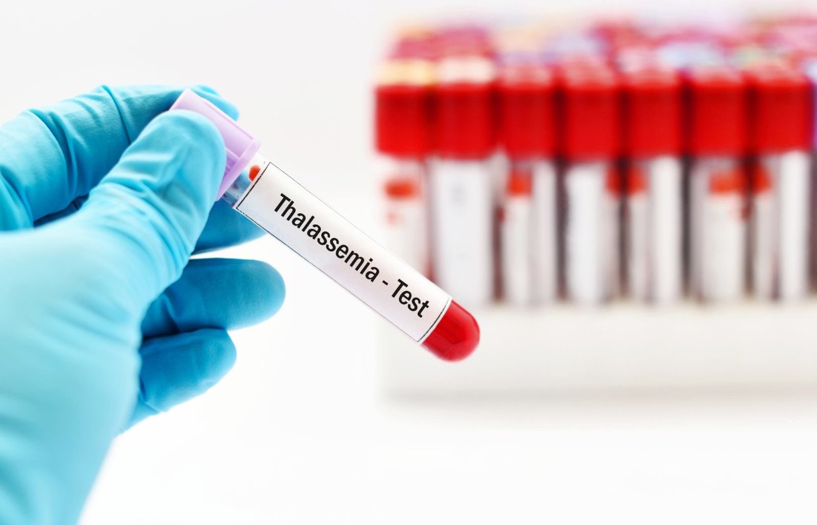 Thalassemia Symptoms, Types, Diagnosis, & more