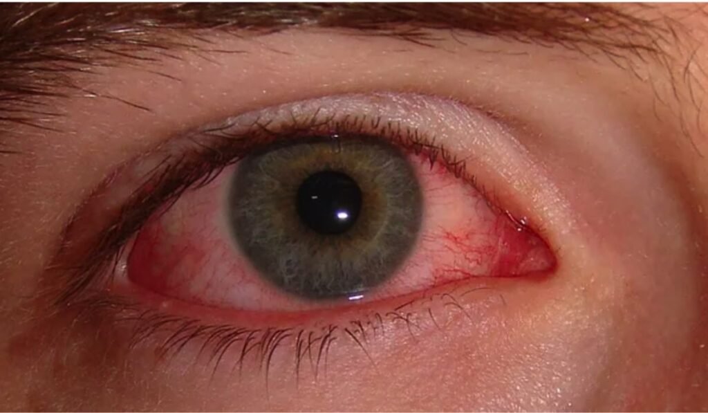 Eye Strain: Your Guide to Prevention