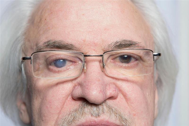 Cataract Types, Symptoms, Causes, & more