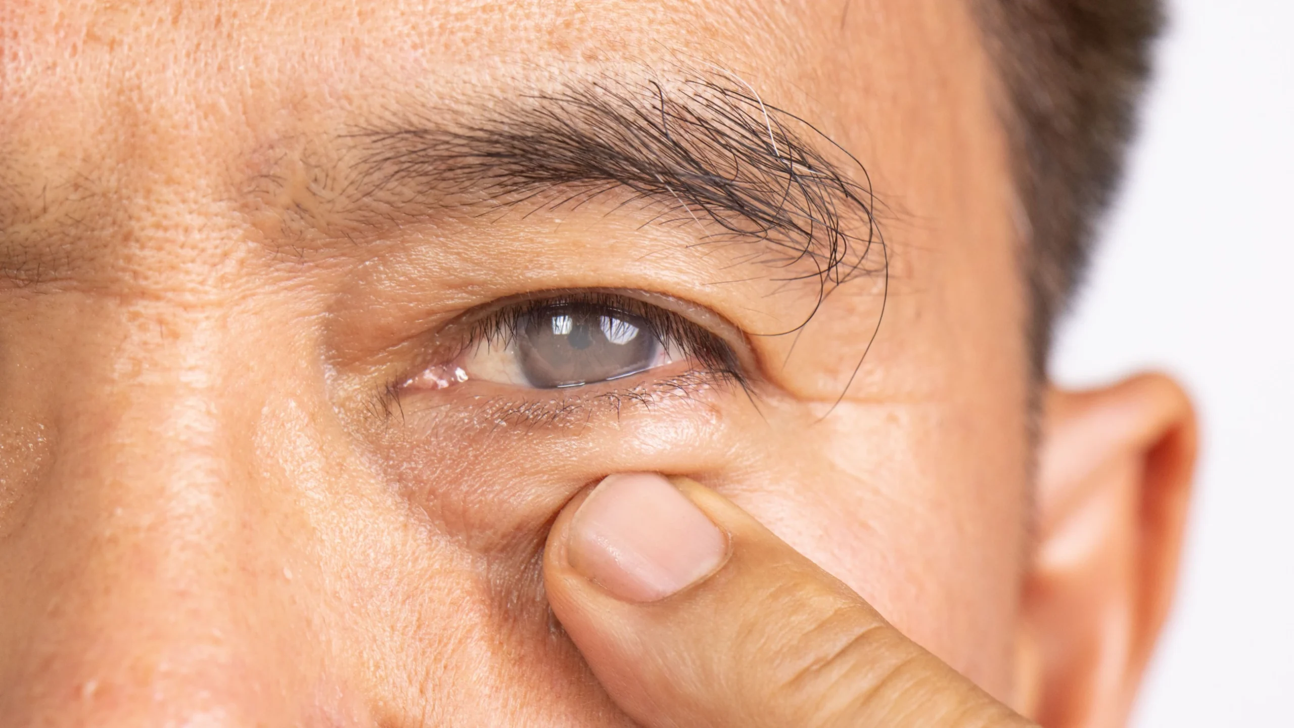 Cataract Types, Symptoms, Causes, & more